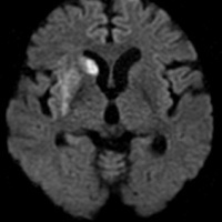頭部ディヒュージョン（脳梗塞）
