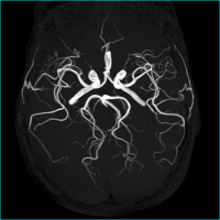 頭部MRA