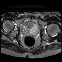 前立腺がん（T2脂肪抑制）