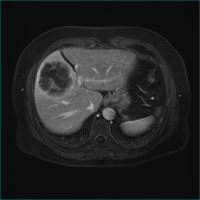 肝がん（造影後）